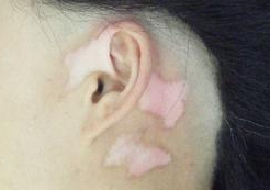 白癜风有什么危害