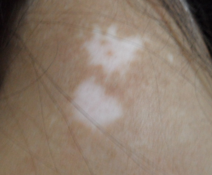 白癜风患者怎么才能做到心里调节